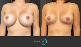 Breast Fat Transfer Before & After Gallery - Patient 285620 - Image 2