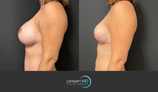 Breast Fat Transfer Before & After Gallery - Patient 285620 - Image 3