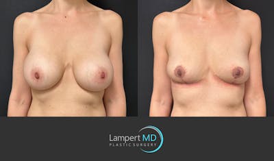Breast Explant Before & After Gallery - Patient 408840 - Image 1