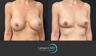 Breast Explant Before & After Gallery - Patient 408840 - Image 2