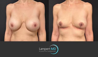 Breast Explant Before & After Gallery - Patient 408840 - Image 3