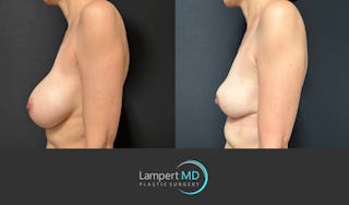 Breast Explant Before & After Gallery - Patient 408840 - Image 5