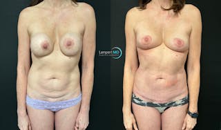 Tummy Tuck Before & After Gallery - Patient 283578 - Image 1