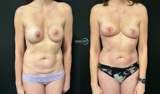 Tummy Tuck Before & After Gallery - Patient 283578 - Image 2