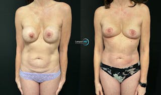 Tummy Tuck Before & After Gallery - Patient 283578 - Image 3