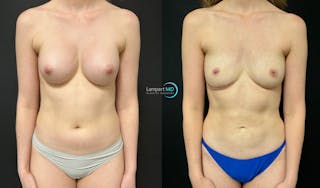 Breast Explant Before & After Gallery - Patient 391956 - Image 3