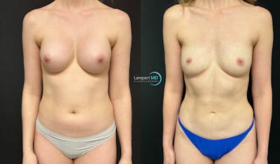 Breast Explant Before & After Gallery - Patient 391956 - Image 1