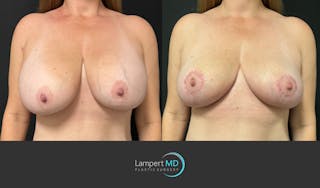 Breast Explant Before & After Gallery - Patient 125736 - Image 1