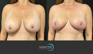 Breast Explant Before & After Gallery - Patient 125736 - Image 2