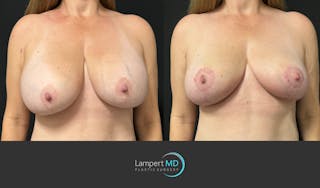 Breast Explant Before & After Gallery - Patient 125736 - Image 3