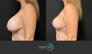 Breast Explant Before & After Gallery - Patient 125736 - Image 5