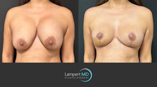 Breast Explant Before & After Gallery - Patient 830126 - Image 2