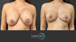 Breast Explant Before & After Gallery - Patient 830126 - Image 3