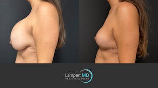 Breast Explant Before & After Gallery - Patient 830126 - Image 4
