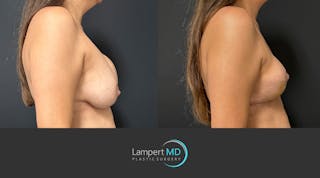 Breast Explant Before & After Gallery - Patient 830126 - Image 5