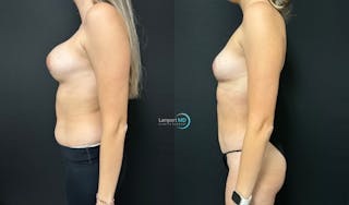 Breast Fat Transfer Before & After Gallery - Patient 232859 - Image 4