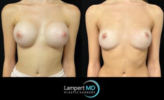Breast Fat Transfer Before & After Gallery - Patient 407116 - Image 1