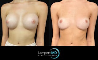 Breast Fat Transfer Before & After Gallery - Patient 407116 - Image 3