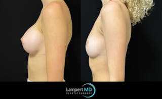 Breast Fat Transfer Before & After Gallery - Patient 407116 - Image 5