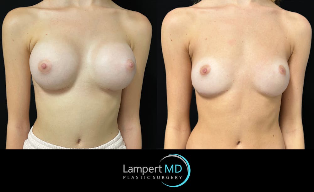Breast Fat Transfer Before & After Gallery - Patient 407116 - Image 2