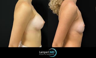 Breast Fat Transfer Before & After Gallery - Patient 407116 - Image 4