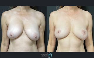 Breast Fat Transfer Before & After Gallery - Patient 140445 - Image 1