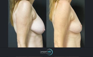 Breast Fat Transfer Before & After Gallery - Patient 140445 - Image 3