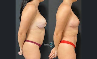 Breast Fat Transfer Before & After Gallery - Patient 221769 - Image 3