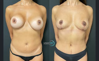 Breast Fat Transfer Before & After Gallery - Patient 432014 - Image 1