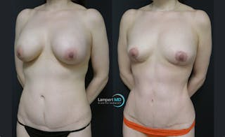 Breast Fat Transfer Before & After Gallery - Patient 112429 - Image 2