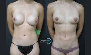 Breast Fat Transfer Before & After Gallery - Patient 262840 - Image 2
