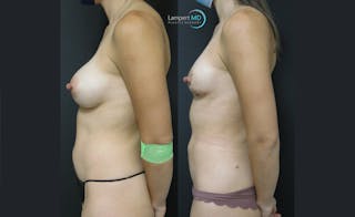 Breast Fat Transfer Before & After Gallery - Patient 262840 - Image 6