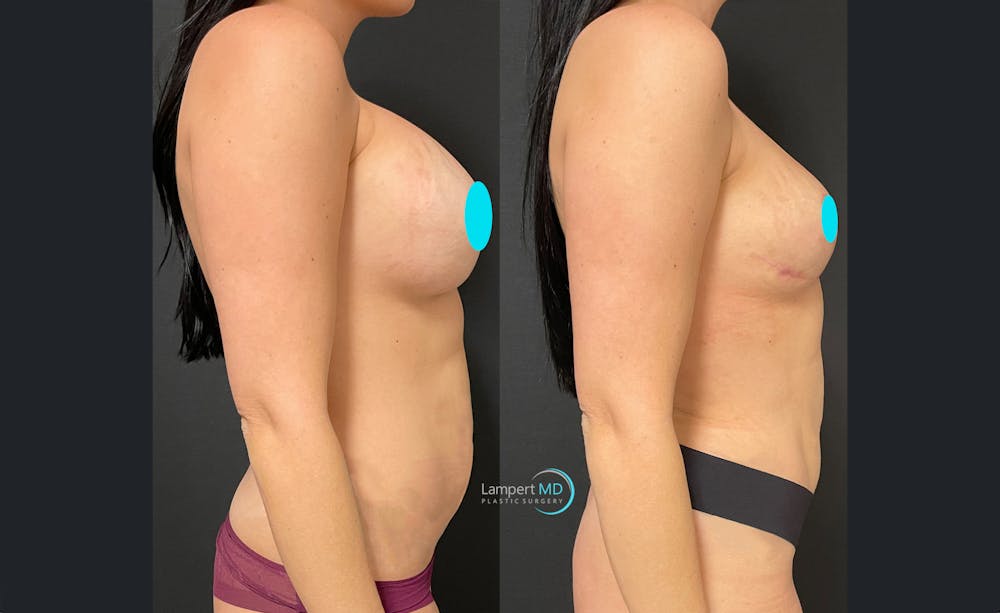 Breast Fat Transfer Before & After Gallery - Patient 174926 - Image 3