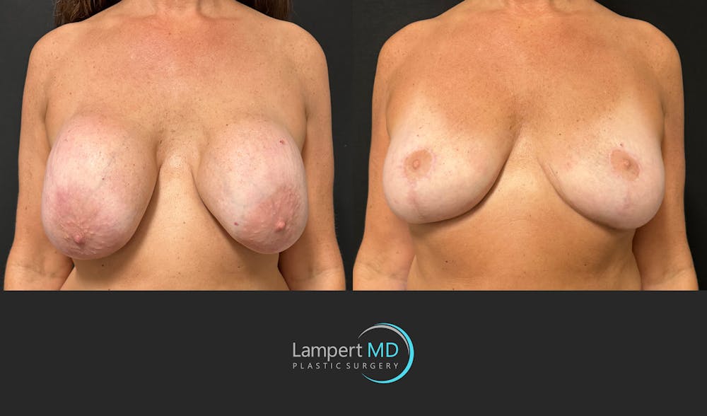 Breast Explant Before & After Gallery - Patient 157606 - Image 1