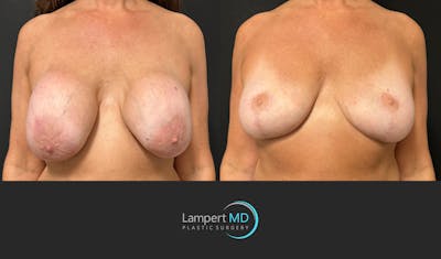 Breast Explant Before & After Gallery - Patient 157606 - Image 1