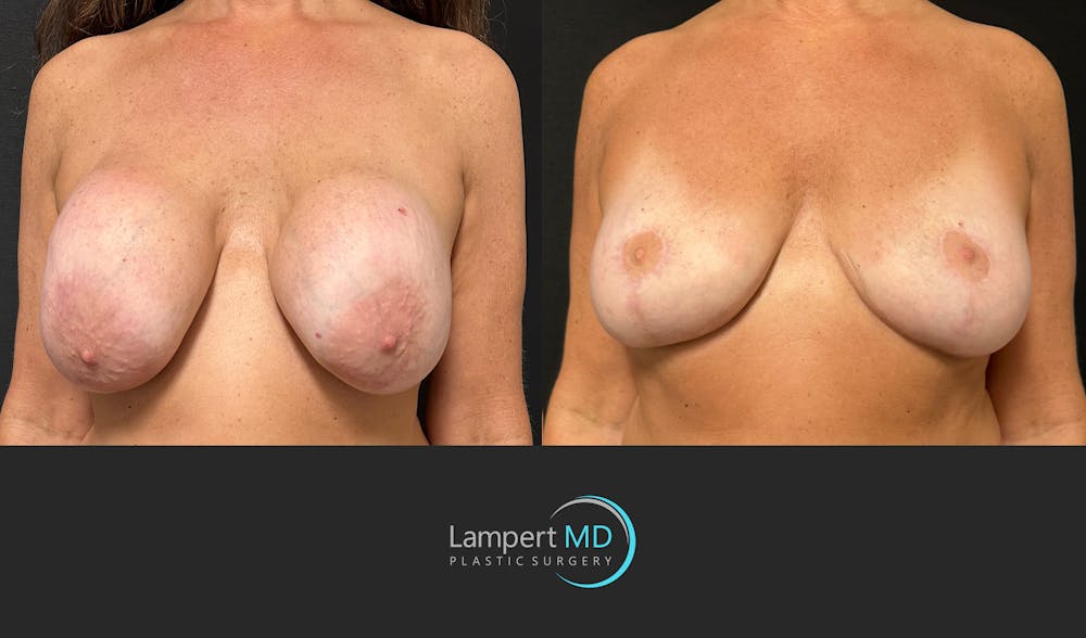 Breast Explant Before & After Gallery - Patient 157606 - Image 2