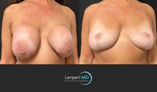 Breast Explant Before & After Gallery - Patient 157606 - Image 3