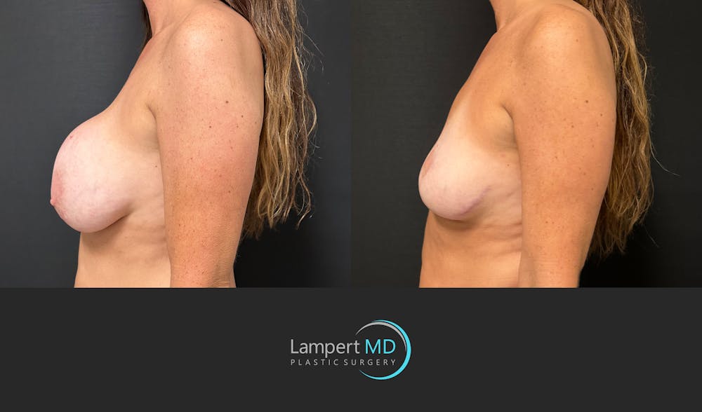 Breast Explant Before & After Gallery - Patient 157606 - Image 4