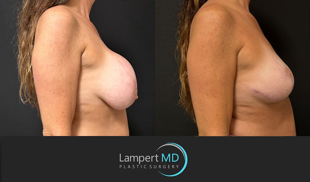 Breast Explant Before & After Gallery - Patient 157606 - Image 5