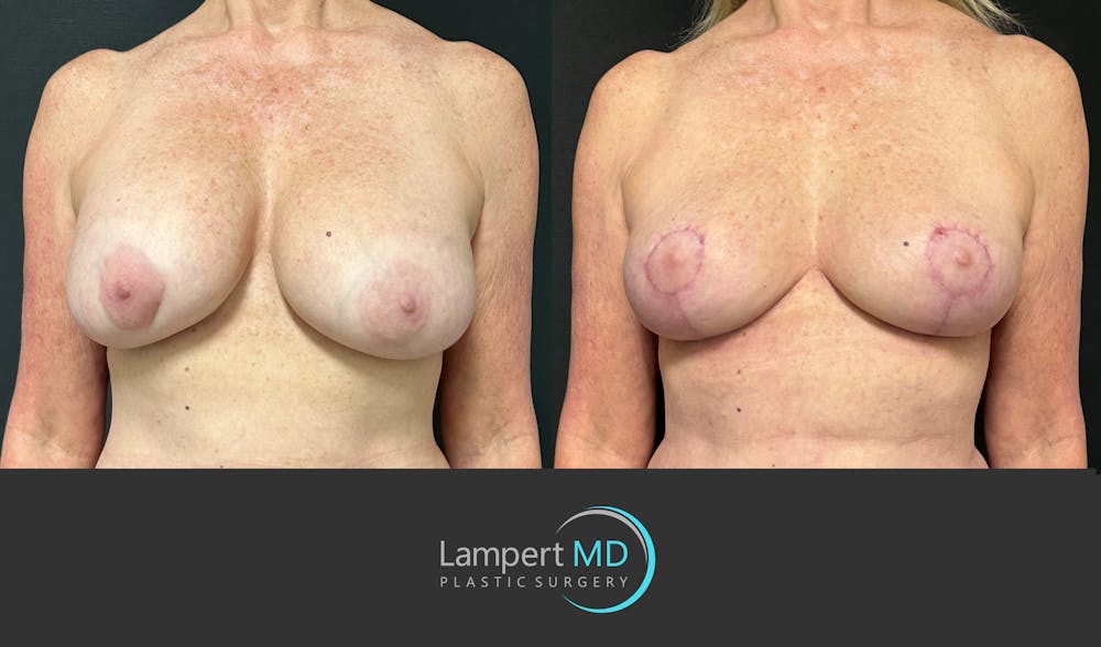 Breast Explant Before & After Gallery - Patient 322160 - Image 3