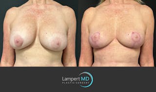 Breast Explant Before & After Gallery - Patient 322160 - Image 3