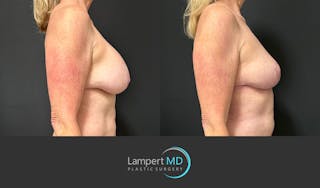 Breast Explant Before & After Gallery - Patient 322160 - Image 4