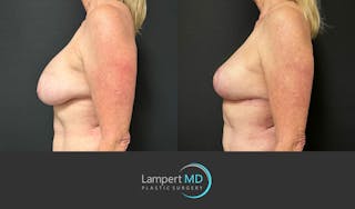 Breast Explant Before & After Gallery - Patient 322160 - Image 5