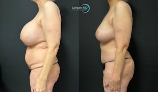 Breast Explant Before & After Gallery - Patient 113290 - Image 5