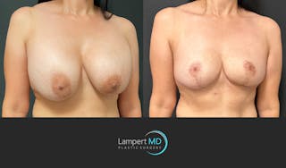 Breast Explant Before & After Gallery - Patient 272177 - Image 2