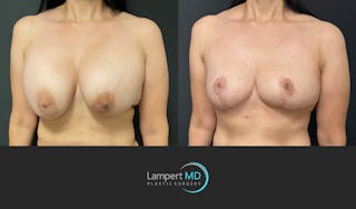 Breast Explant Before & After Gallery - Patient 272177 - Image 3