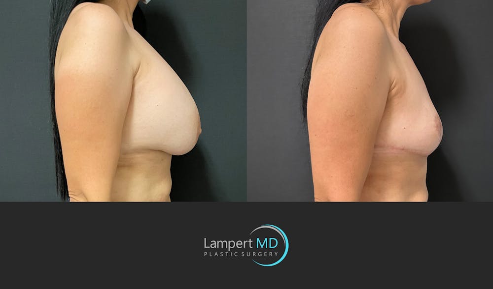 Breast Explant Before & After Gallery - Patient 272177 - Image 4