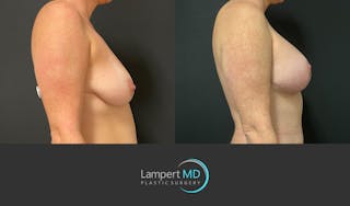 Breast Augmentation Before & After Gallery - Patient 143556105 - Image 4