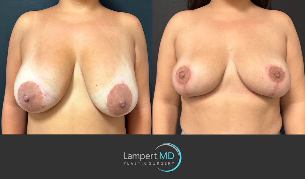 Breast Explant Before & After Gallery - Patient 276775 - Image 1