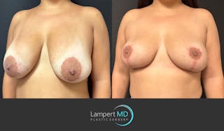 Breast Explant Before & After Gallery - Patient 276775 - Image 4